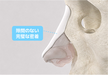 3Dカスタム鼻整形 SOFIT