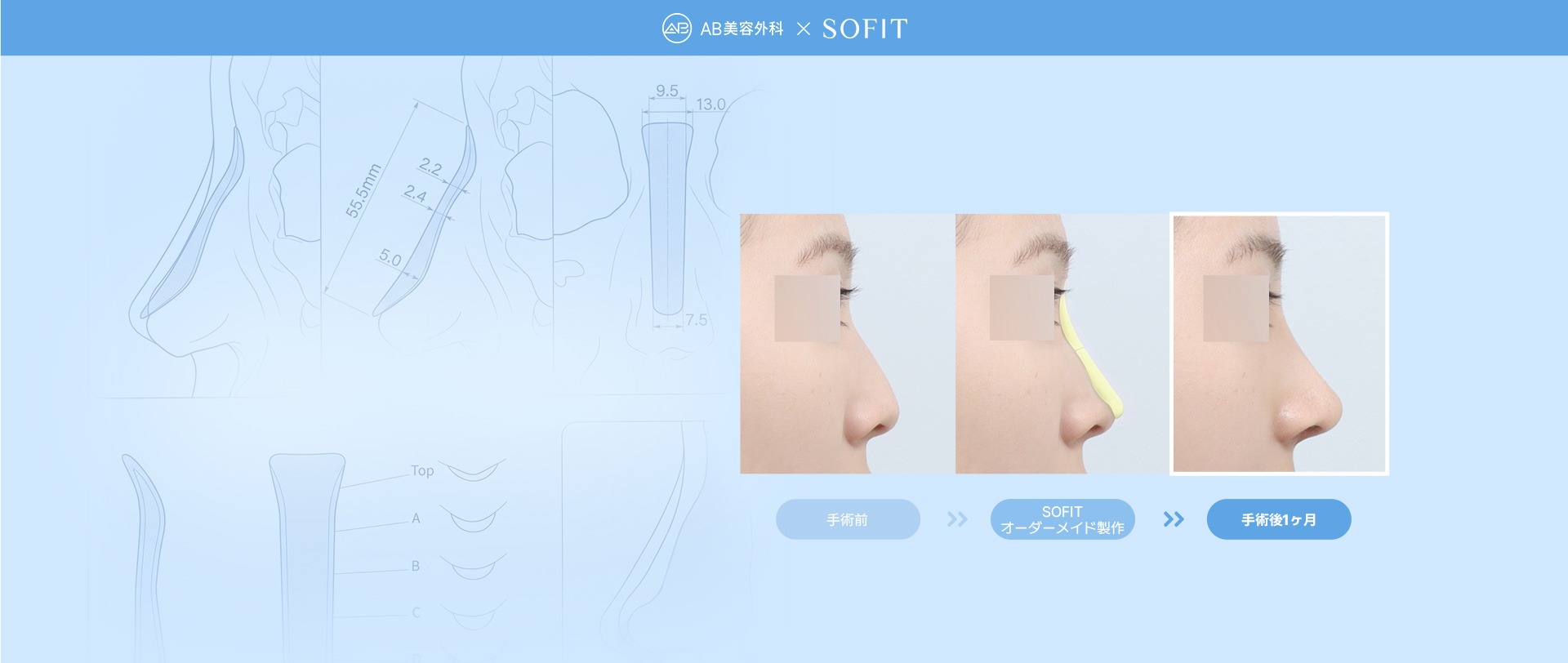 Sofit Nose