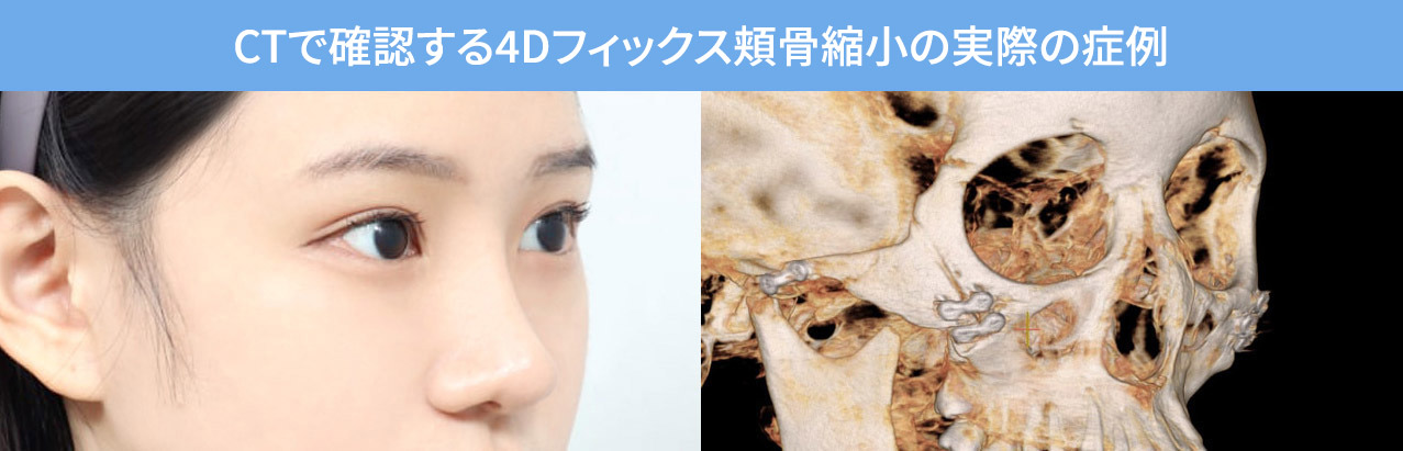 CTで確認する4Dフィックス頬骨縮小の実際の症例