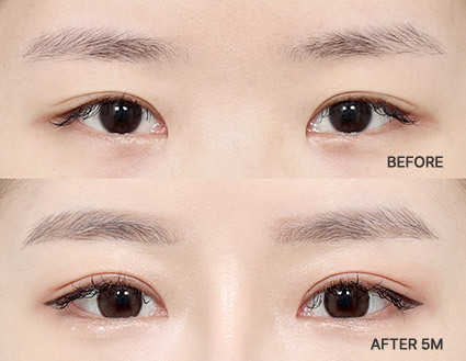 韓国での眼瞼再手術