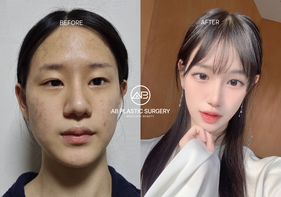AB整形外科の顔全体整形前後比較