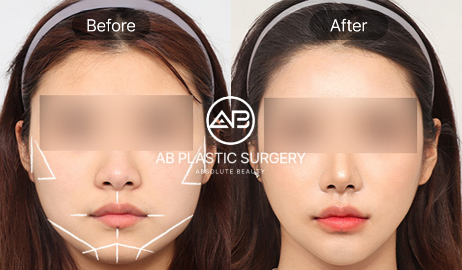 AB美容外科でエラ削りと輪郭手術を受けた女性のビフォーアフター写真