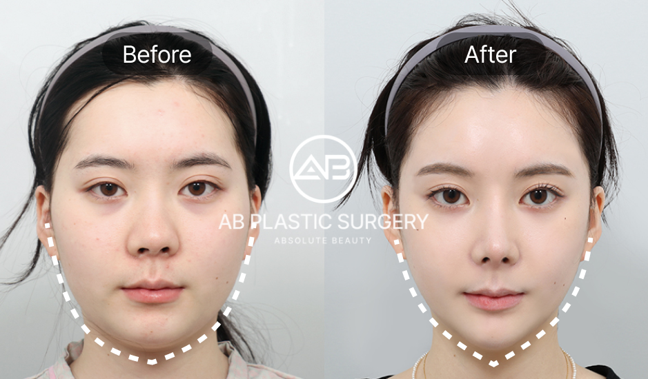 エラ削り手術後の回復でフェイスラインが改善された女性のビフォーアフター写真