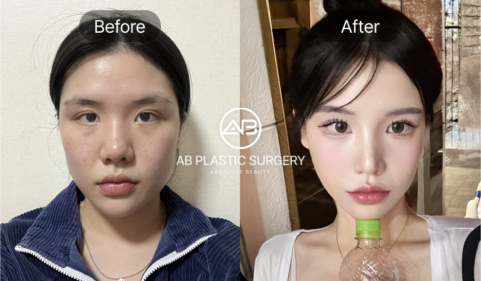 AB美容外科の小鼻縮小+鼻先形成のビフォーアフター