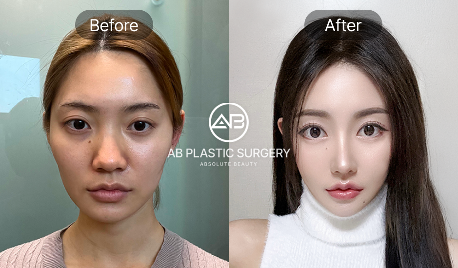 AB美容外科の自然癒着二重術+トミ整形によるビフォーアフター