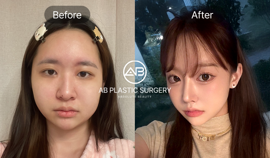 AB美容外科の輪郭3点+自家肋軟骨鼻整形のビフォーアフター