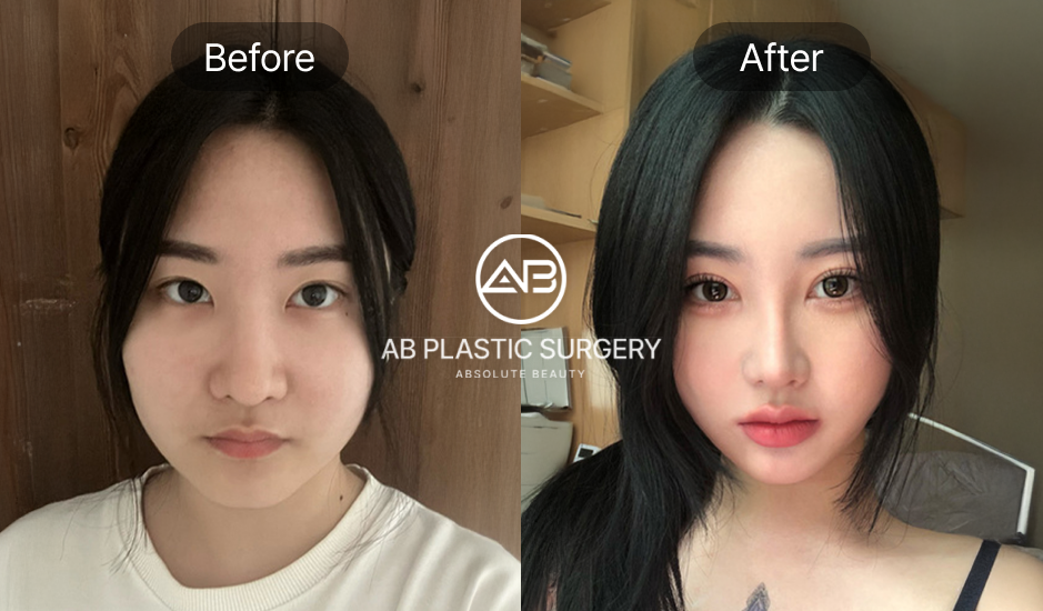 「3泊4日」で印象を変えたい方におすすめのAB美容外科短期整形プラン