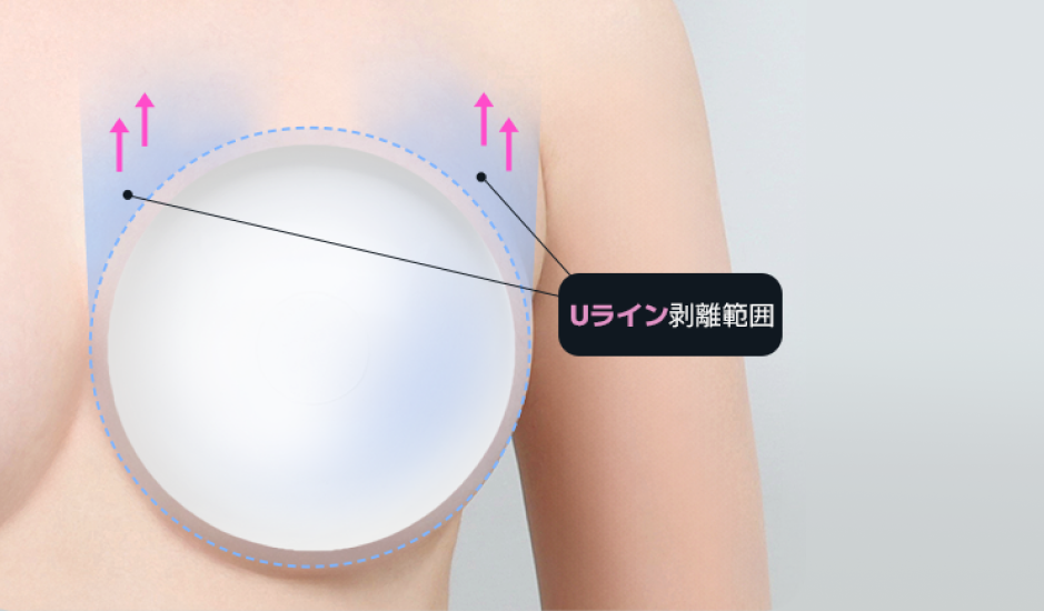 韓国豊胸Uライン剥離設計図|AB美容外科の3DシミュレーションとABCDE分析に基づいたプロテーゼ挿入範囲
