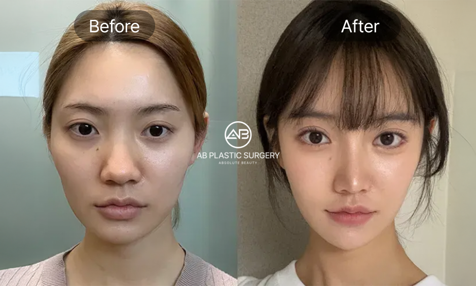 小鼻縮小の前後写真、鼻の穴が目立つ印象を改善し自然な顔立ちを実現したAB美容外科韓国の症例