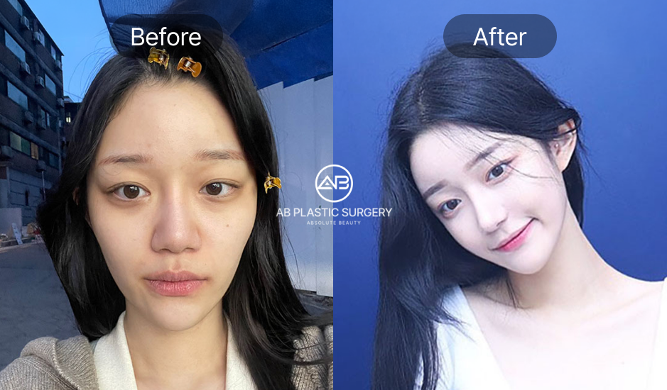 韓国美容ツアー 輪郭手術 小顔 Vライン形成 前後写真 AB美容外科韓国 自然で整った顔の変化