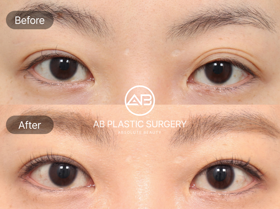 目尻切開・目下切開のビフォーアフター写真。AB美容外科韓国の症例で横と縦を同時に広げ、自然で立体的な大きな目元を実現