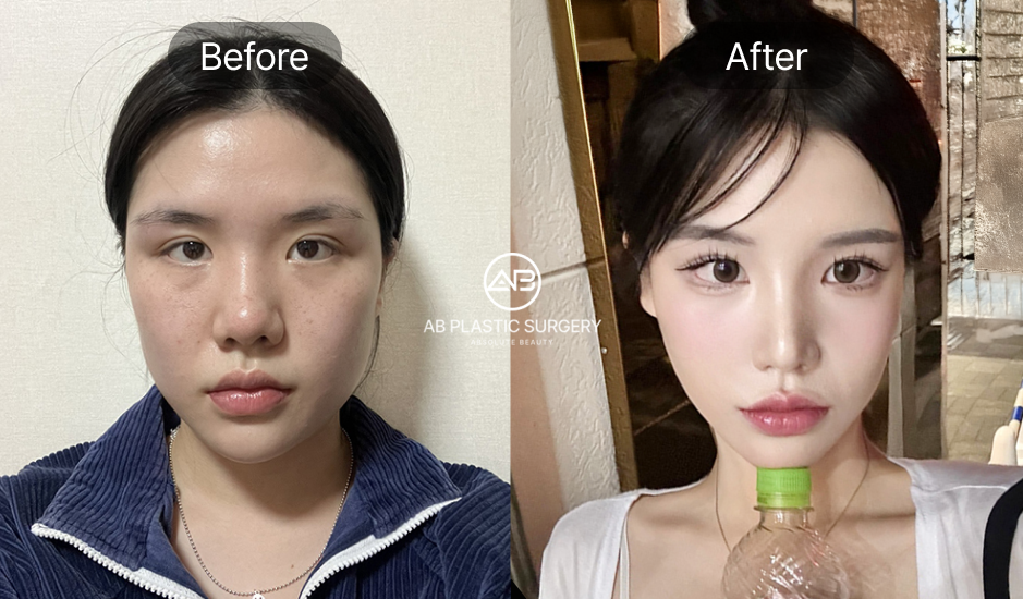 小鼻縮小の前後写真、正面から大きく見える鼻を改善し自然にすっきりとした印象を与えたAB美容外科韓国の症例