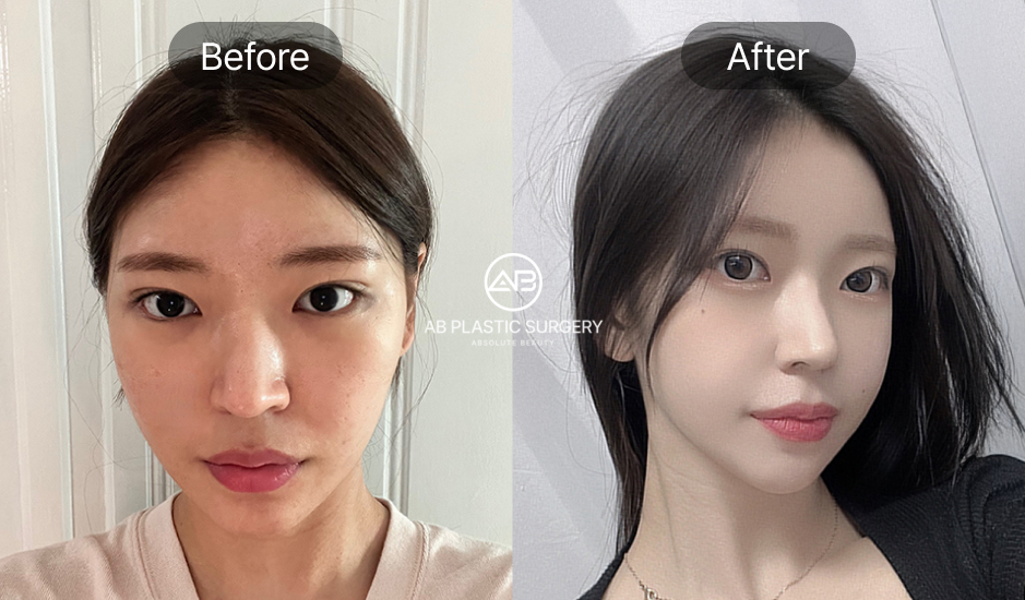 小鼻縮小の前後写真、丸みのある鼻先と横に広がった小鼻を改善し女性らしい横顔を実現したAB美容外科韓国の症例