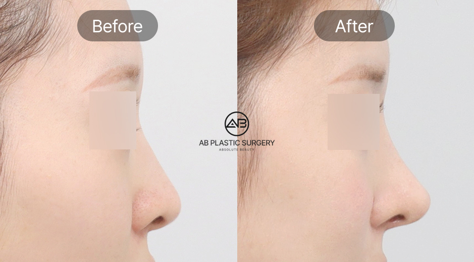 韓国AB美容外科の団子鼻整形ビフォーアフター写真 横顔の団子鼻改善効果を示す症例画像