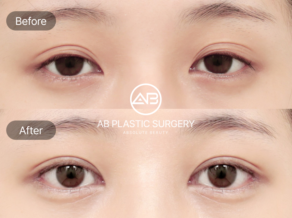 タレ目整形 韓国美容外科 AB美容外科 症例写真 — 目元の変化がわかるビフォーアフター写真