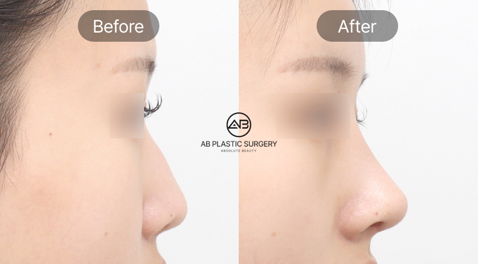 韓国AB美容外科の団子鼻整形ビフォーアフター写真 横顔から見た鼻のライン改善効果を示す症例画像