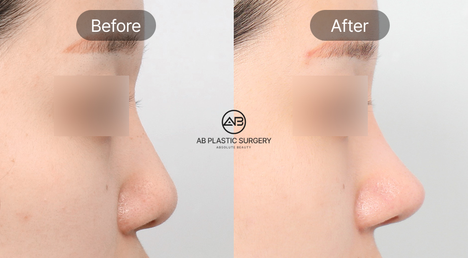 韓国AB美容外科の団子鼻整形ビフォーアフター写真 横顔から見た鼻先ラインの改善を示す症例画像