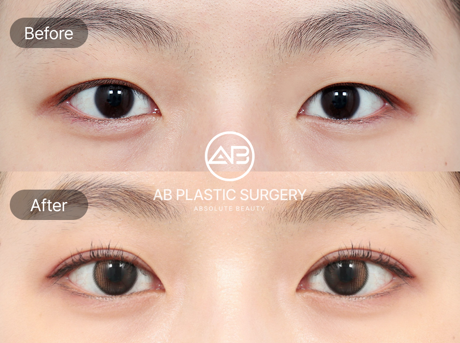 切開法タレ目整形 韓国美容外科 AB美容外科 症例 — 目尻切開と下眼瞼下制術によるビフォーアフター写真