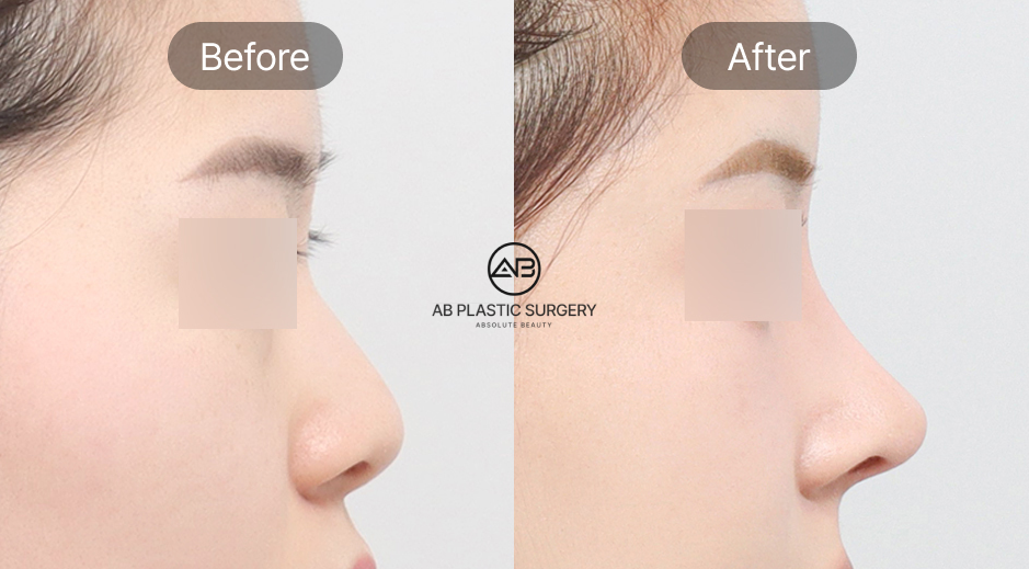 韓国AB美容外科の団子鼻整形ビフォーアフター写真。鼻尖形成術による鼻先の改善効果を示す症例画像