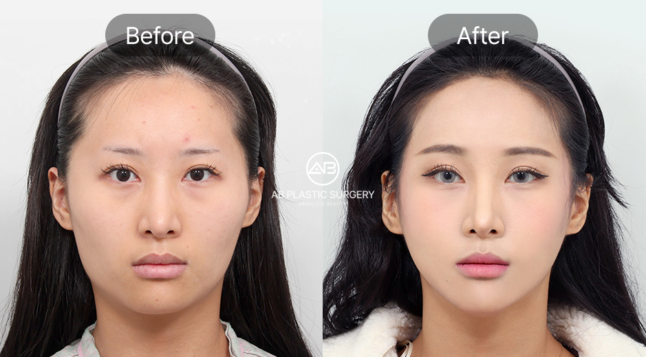 韓国AB美容外科の輪郭3点手術ビフォーアフター写真、エラ削り・顎先形成・頬骨縮小による小顔効果