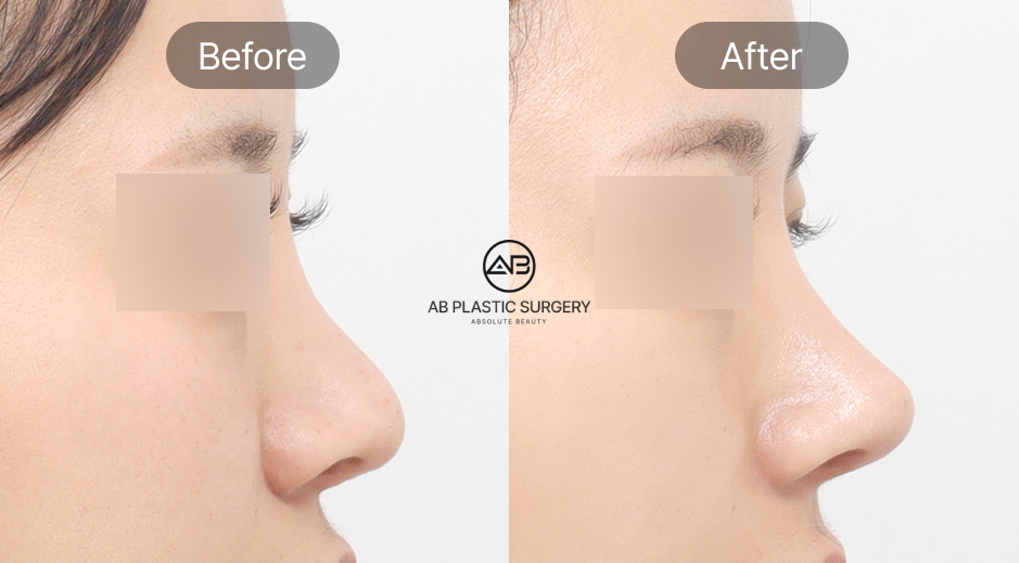 韓国AB美容外科の団子鼻整形ビフォーアフター写真 ヒアルロン酸注射による鼻筋形成と団子鼻改善効果を示す症例画像