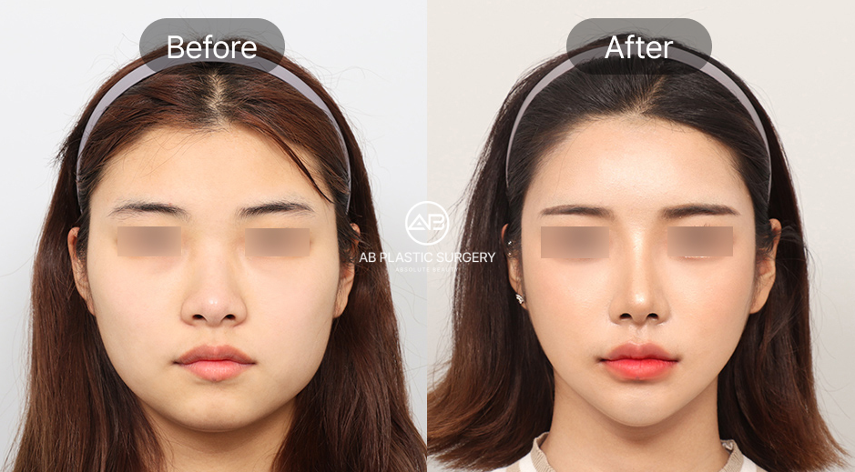 韓国AB美容外科の輪郭3点手術ビフォーアフター写真、エラ張り解消とVライン形成による小顔効果