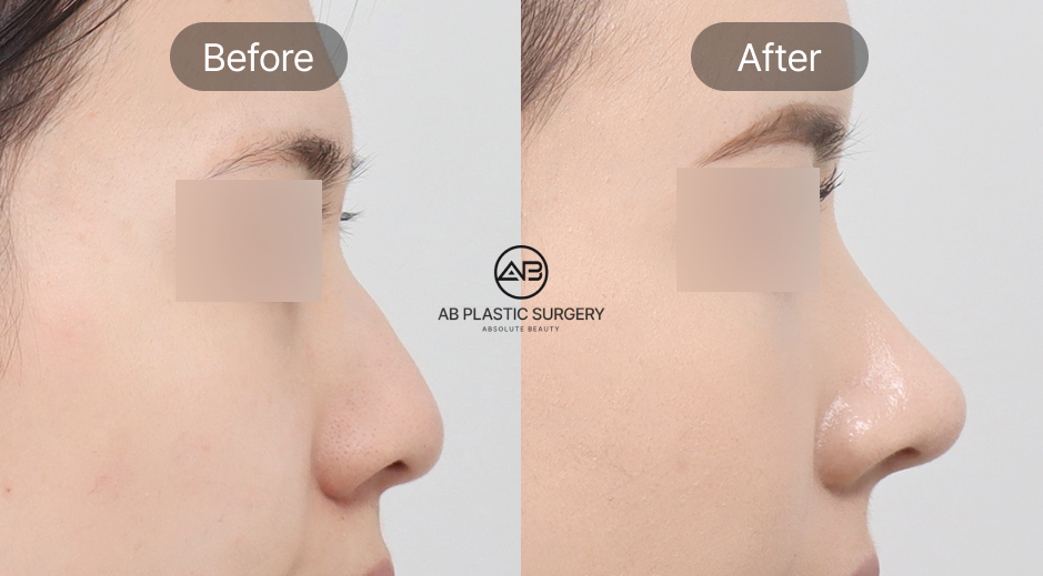 韓国AB美容外科の団子鼻整形ビフォーアフター写真 セルフケアと美容整形の効果比較を示す横顔症例画像
