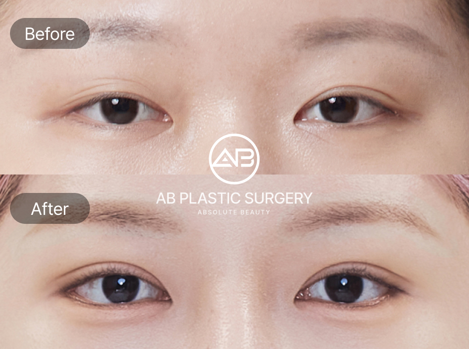 タレ目整形 症例写真 AB美容外科 — 切らない方法と切開法による自然な変化を示すビフォーアフター