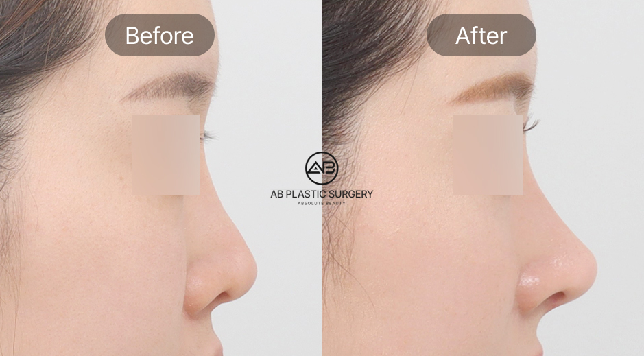 韓国AB美容外科の団子鼻整形ビフォーアフター写真 セルフケアと美容整形の効果の違いを示す横顔症例