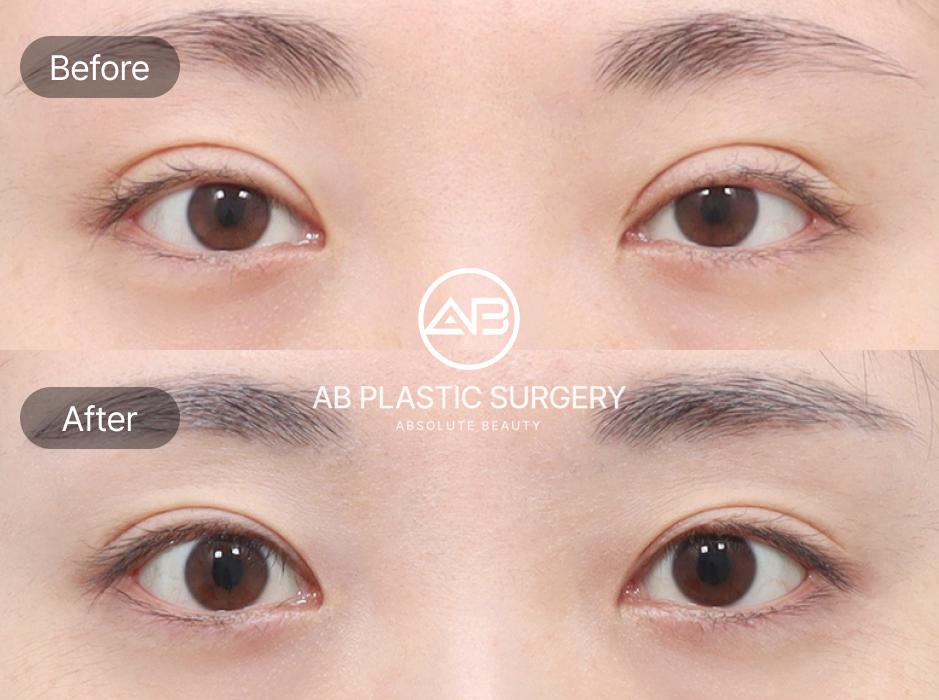 タレ目整形 失敗と回避方法 AB美容外科 症例 — 不自然さや左右差を防ぐためのビフォーアフター写真