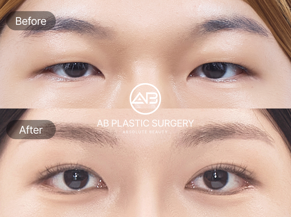 タレ目整形 まとめ AB美容外科 症例 — 後悔しない施術選びを示すビフォーアフター写真