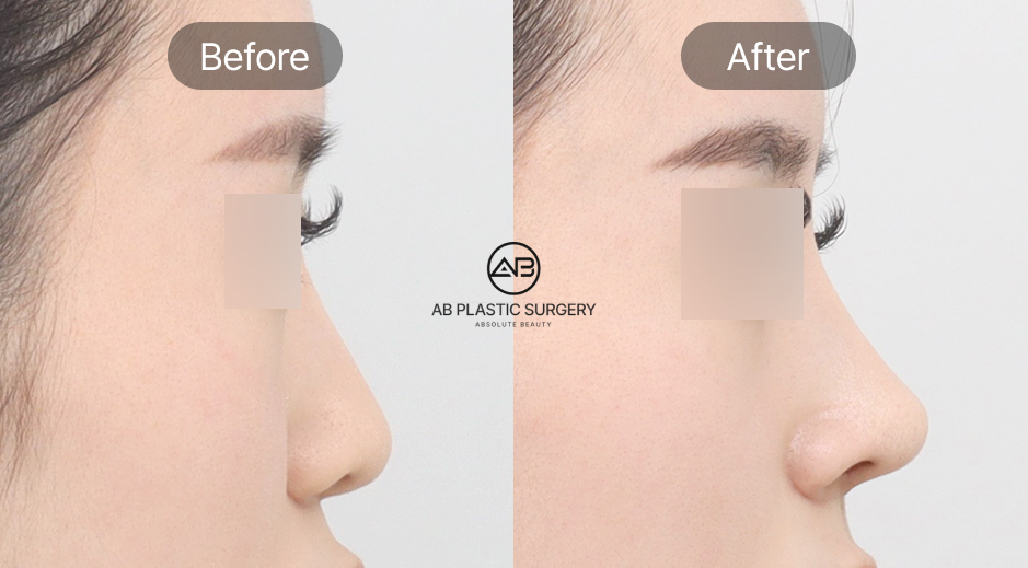 韓国AB美容外科の団子鼻整形ビフォーアフター写真。費用や持続性を考慮した改善法選びの参考症例。団子鼻改善、鼻整形、美容整形の前後写真