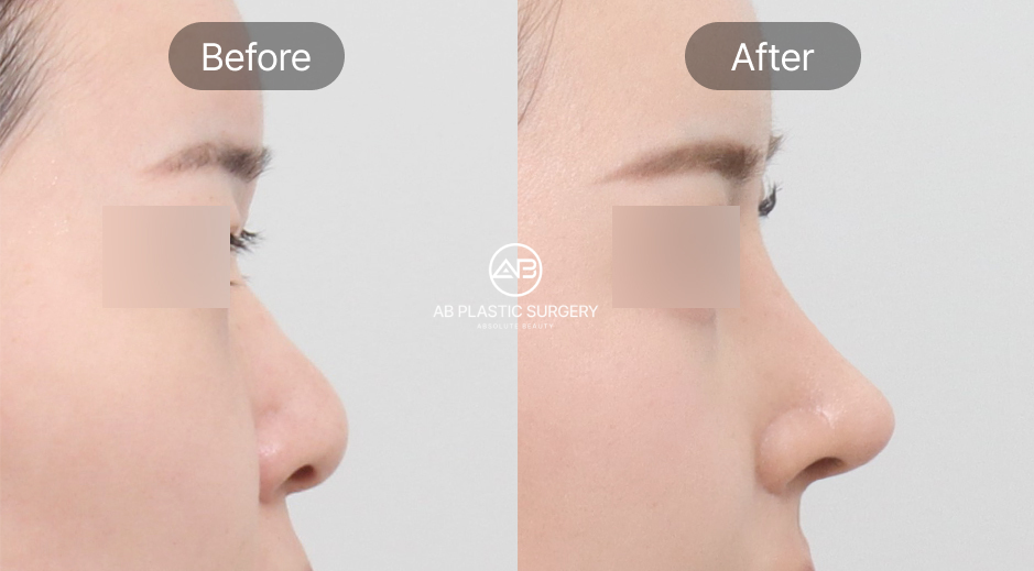 鼻尖形成 ビフォーアフター 団子鼻 改善 韓国AB美容外科 鼻先整形 自然な鼻先ライン