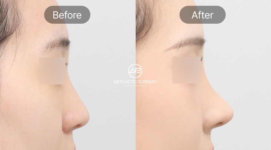 鼻尖形成 ビフォーアフター 韓国AB美容外科 団子鼻 改善 自然な鼻先デザイン 横顔ラインの変化