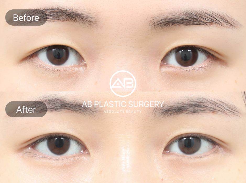 韓国AB美容外科 目尻切開 外眼角形成 切れ長の目 横幅拡大 目の形改善 二重固定法 前後写真