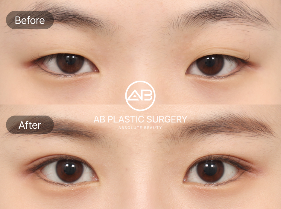 韓国AB美容外科 つり目矯正 吊り上げ術 目尻リフト バランス調整 若々しい目元 デザイン矯正 前後写真
