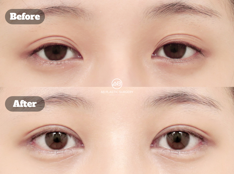 韓国で非切開眼矯正・目尻切開・下眼瞼下制術を組み合わせた目元整形のビフォーアフター