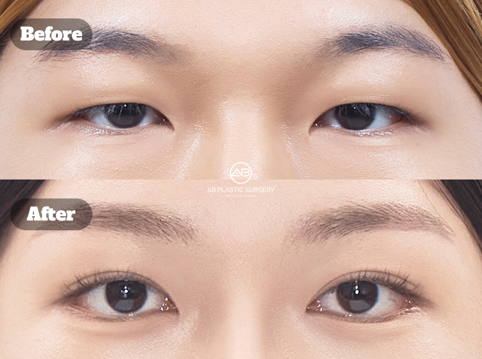 韓国で目頭切開と目尻切開、下眼瞼下制術、下眼瞼脂肪除去、切開眼矯正を組み合わせた目元整形のビフォーアフター