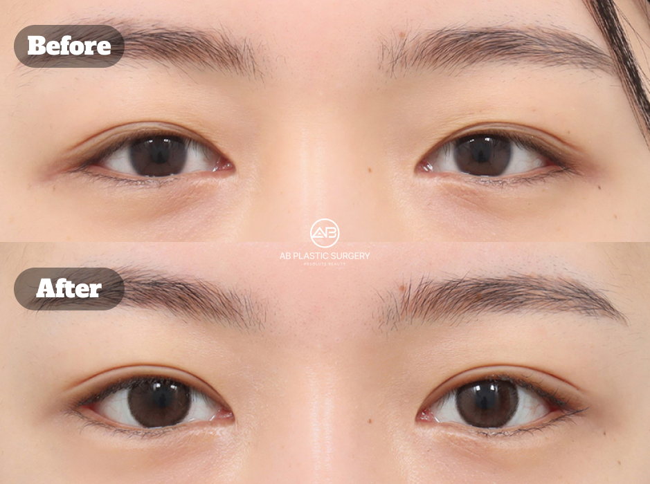 韓国で再手術として目頭切開と目尻切開を行った目元整形のビフォーアフター