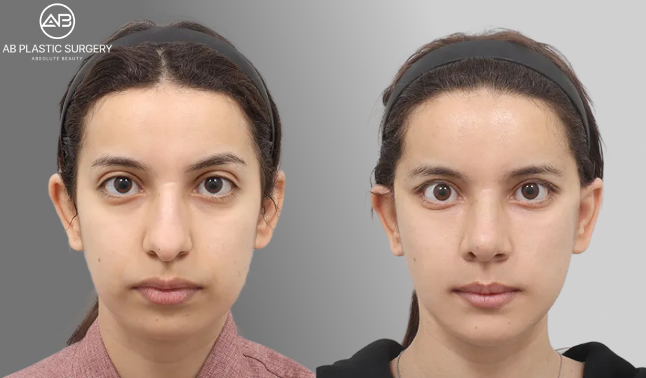 ポニーテールリフト、顔の脂肪吸引、顔の脂肪移植、顎先形成術、無インプラント鼻整形のビフォーアフター写真