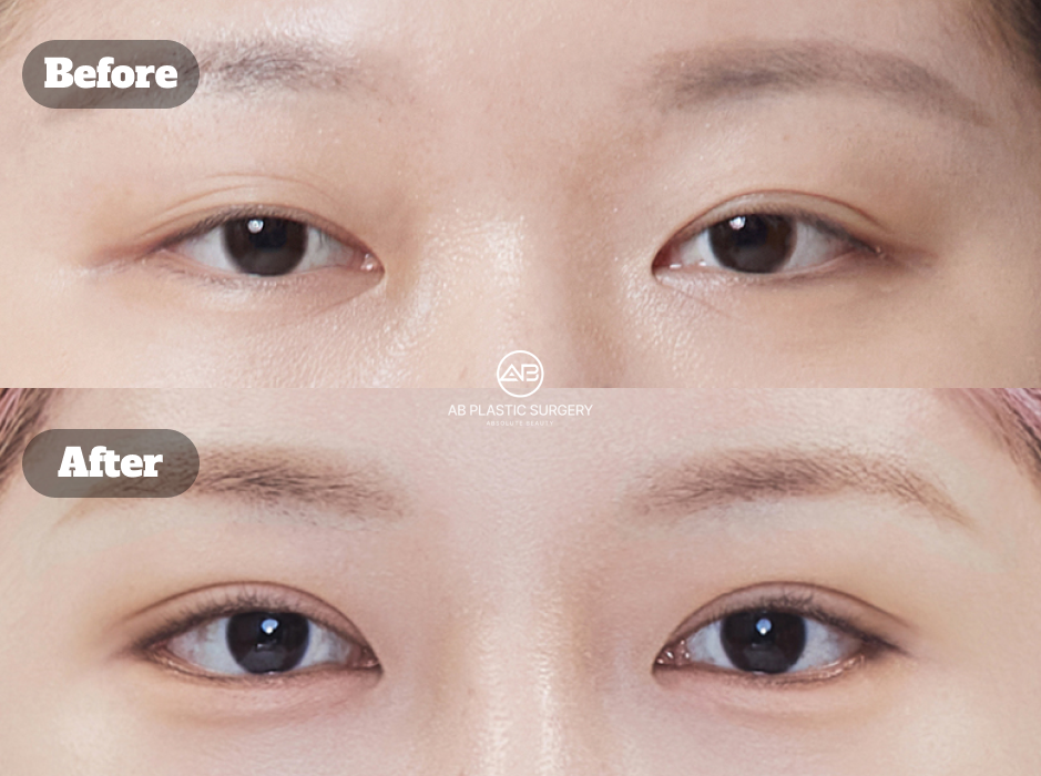 韓国で行われた目尻切開・下眼瞼下制術・非切開眼矯正を組み合わせた手術の術前術後結果