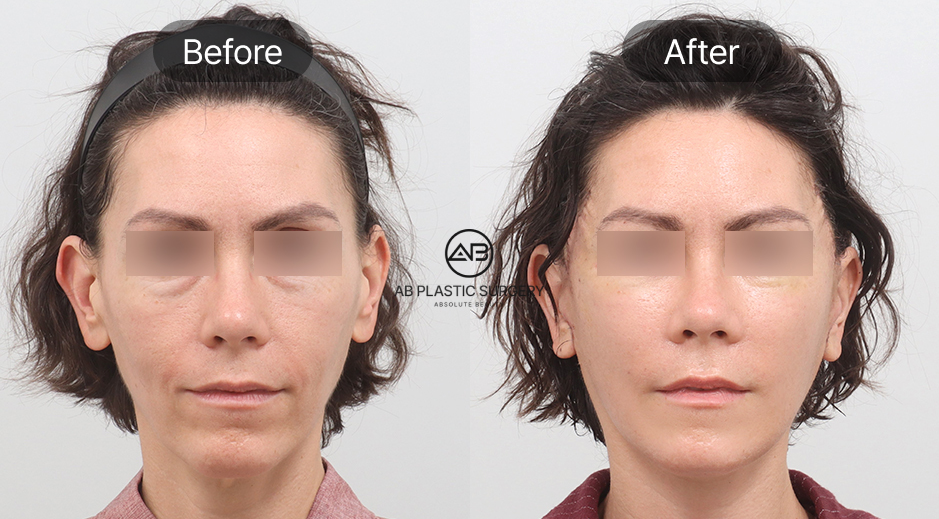 セミフルリフト＋脂肪移植 のビフォーアフター写真
