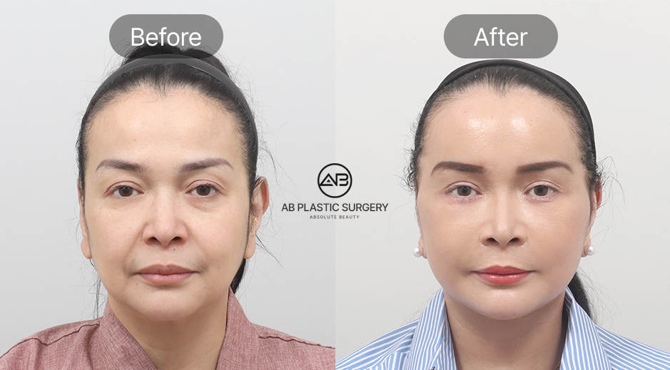 フルSMASリフト＋首リフト＋二重あご脂肪吸引＋顔の脂肪移植 のリフティング写真