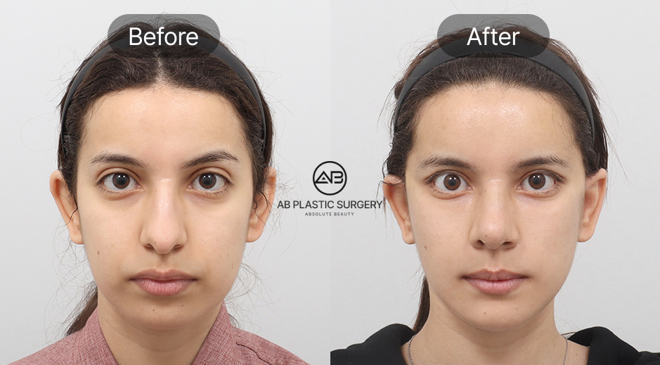 ポニーテールリフト＋頬の脂肪吸引＋顔の脂肪移植 のビフォーアフター写真