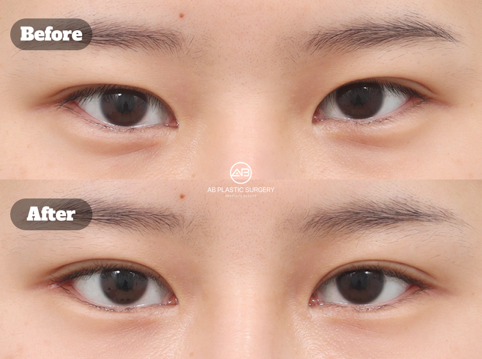 韓国で非切開眼矯正・目尻切開・下眼瞼下制術の再手術を行った目元整形のビフォーアフター