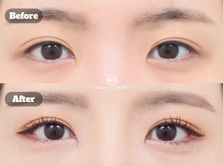 韓国で受けた目尻切開と下眼瞼下制術のビフォーアフター症例レビュー