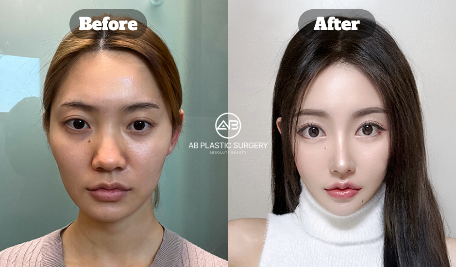 ミニVライン形成で自然なフェイスラインを目指す韓国の顎整形ガイド
