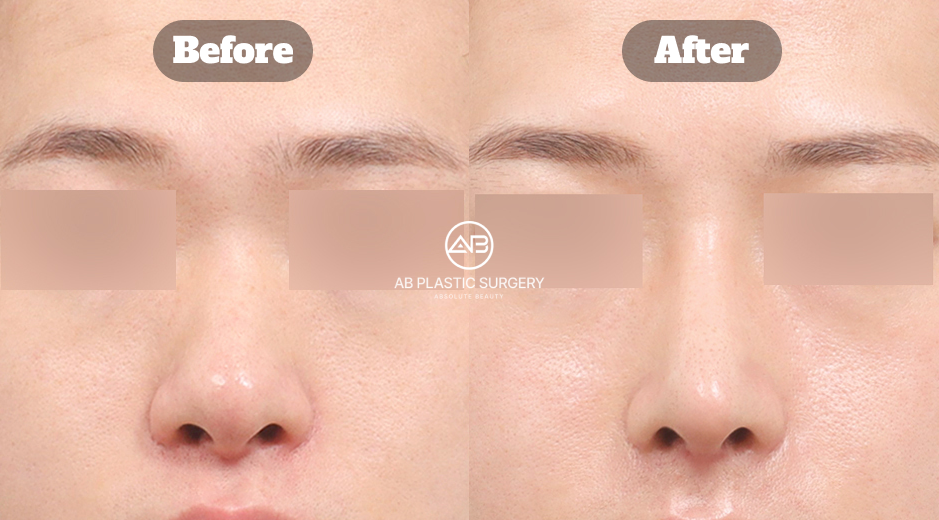 韓国で行われる男性向け鼻整形において、骨や軟骨の歪みが原因となる曲がった鼻をどのように矯正するかを示した症例イメージ