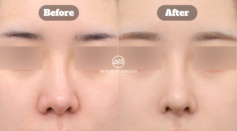AB美容外科韓国で行われた曲がった鼻の矯正手術について、術前後の変化と実際の患者レビューを通じて、どのように鼻の歪みが改善されたかを示す症例画像