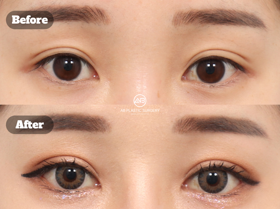 韓国で受けた目尻切開と下眼瞼下制による目元整形のビフォーアフターレビュー